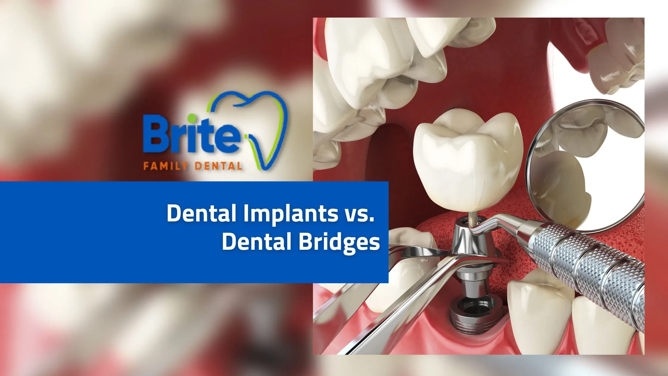 Dental Implants vs. Dental Bridges - Banner