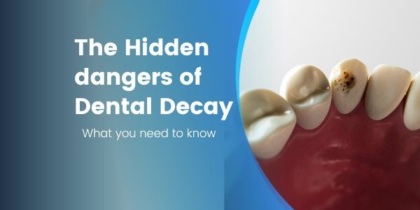 The Hidden Dangers of Dental Decay: What You Need to Know